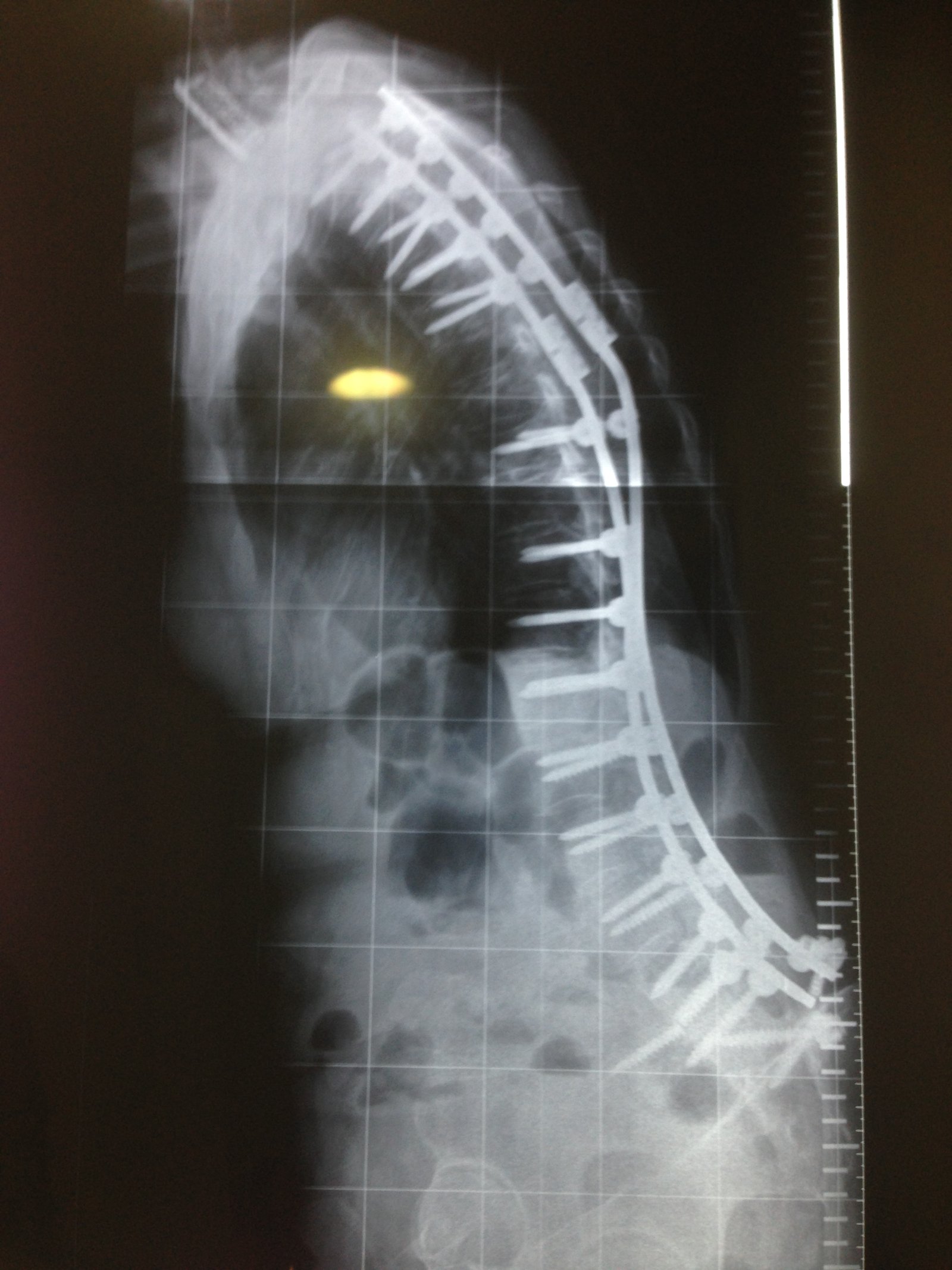 Estimulador de Cordones (SCS)